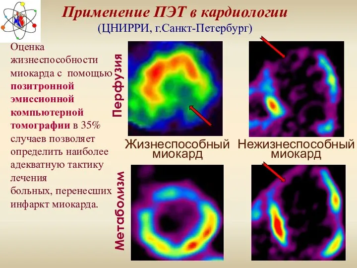 Применение ПЭТ в кардиологии (ЦНИРРИ, г.Санкт-Петербург) Перфузия Метаболизм Жизнеспособный миокард Нежизнеспособный