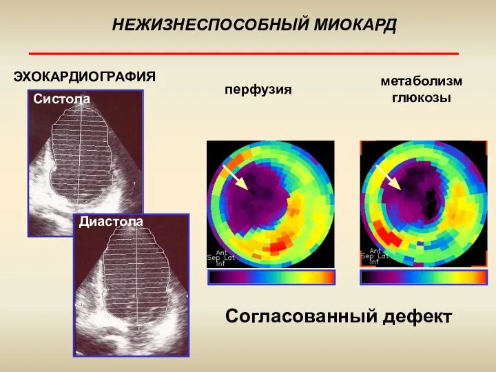 НЕЖИЗНЕСПОСОБНЫЙ МИОКАРД ЭХОКАРДИОГРАФИЯ метаболизм глюкозы перфузия Систола Согласованный дефект Диастола