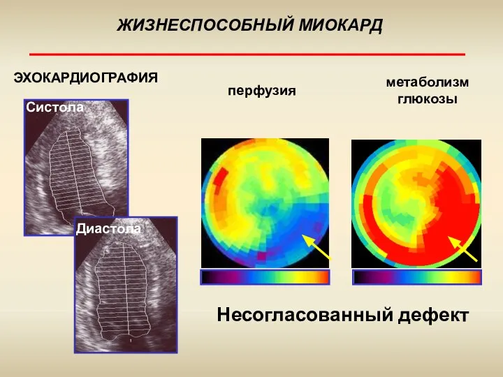 ЖИЗНЕСПОСОБНЫЙ МИОКАРД ЭХОКАРДИОГРАФИЯ метаболизм глюкозы перфузия Систола Несогласованный дефект Диастола