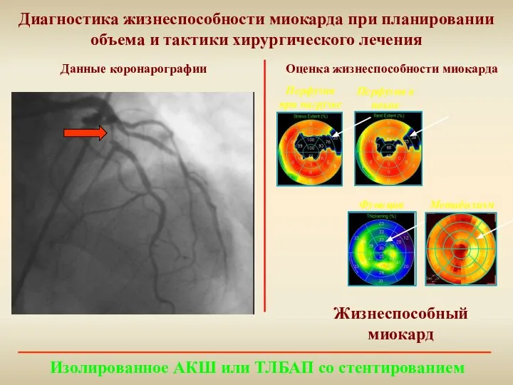 Диагностика жизнеспособности миокарда при планировании объема и тактики хирургического лечения