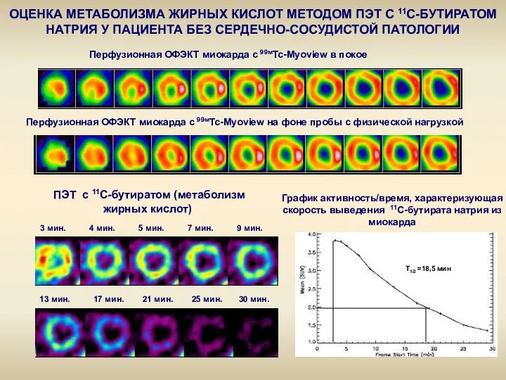 T1/2 =18,5 мин ПЭТ с 11С-бутиратом (метаболизм жирных кислот) 3 мин.