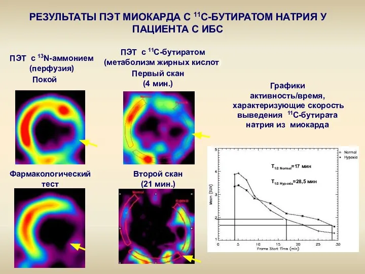 ПЭТ с 13N-аммонием (перфузия) Покой Фармакологический тест ПЭТ с 11С-бутиратом (метаболизм