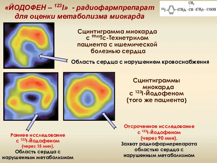 «ЙОДОФЕН – 123I» - радиофармпрепарат для оценки метаболизма миокарда Сцинтиграмма миокарда