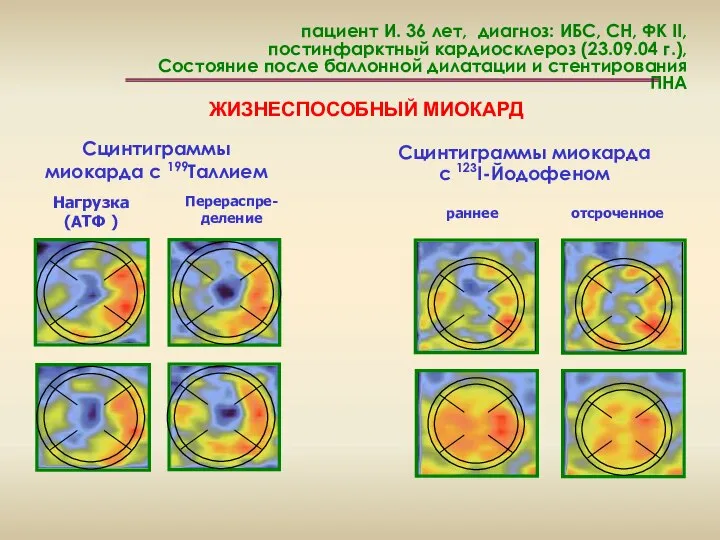 пациент И. 36 лет, диагноз: ИБС, СН, ФК II, постинфарктный кардиосклероз