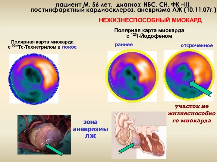 пациент М. 56 лет, диагноз: ИБС, СН, ФК –III, постинфарктный кардиосклероз,