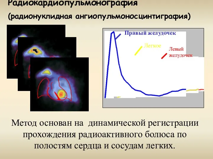 Радиокардиопульмонография (радионуклидная ангиопульмоносцинтиграфия) Метод основан на динамической регистрации прохождения радиоактивного болюса