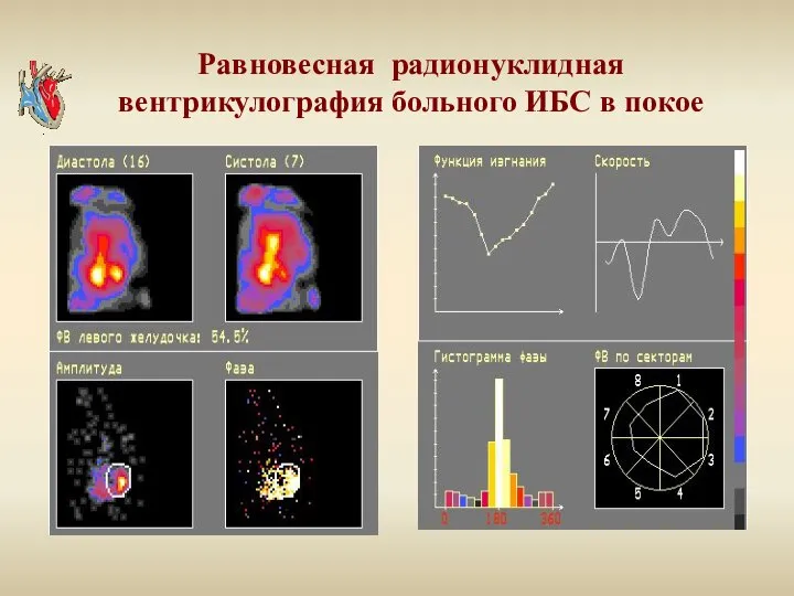 Равновесная радионуклидная вентрикулография больного ИБС в покое