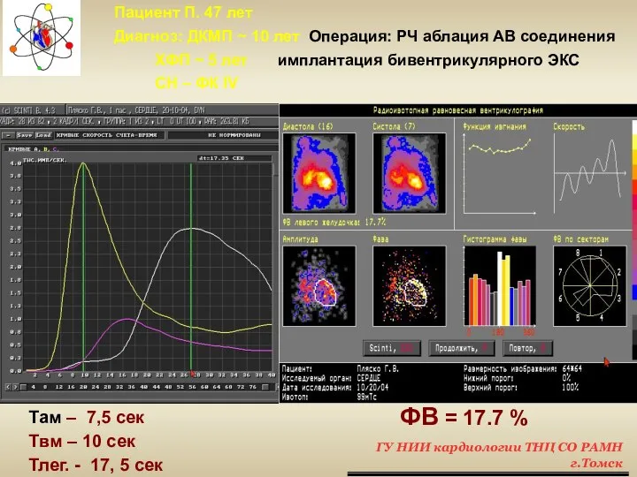 Пациент П. 47 лет Диагноз: ДКМП ~ 10 лет Операция: РЧ