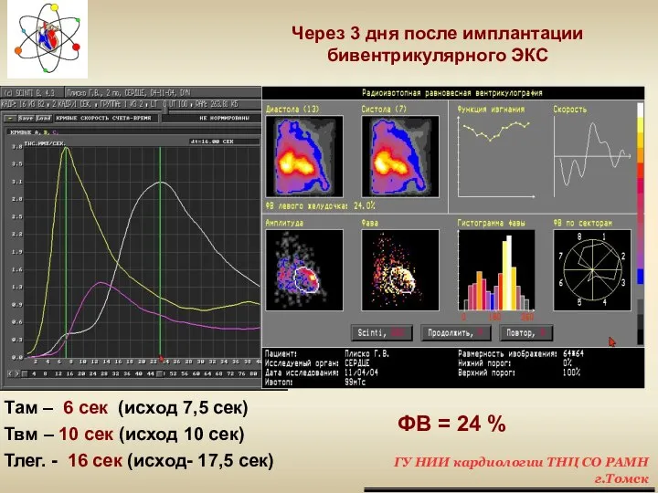 ФВ = 24 % Через 3 дня после имплантации бивентрикулярного ЭКС