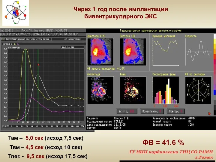 ФВ = 41.6 % Через 1 год после имплантации бивентрикулярного ЭКС