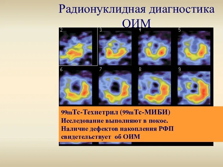 Радионуклидная диагностика ОИМ 99mТс-Технетрил (99mТс-МИБИ) Исследование выполняют в покое. Наличие дефектов накопления РФП свидетельствует об ОИМ