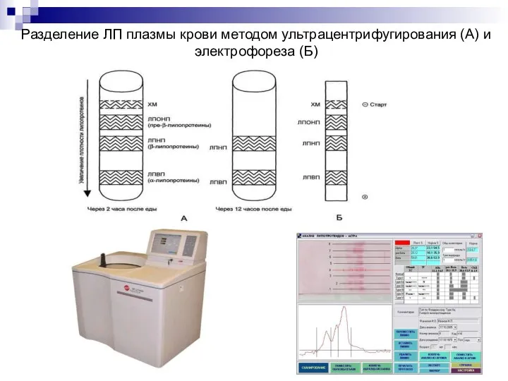 Разделение ЛП плазмы крови методом ультрацентрифугирования (А) и электрофореза (Б)