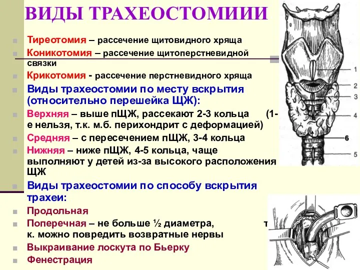 ВИДЫ ТРАХЕОСТОМИИИ Тиреотомия – рассечение щитовидного хряща Коникотомия – рассечение щитоперстневидной