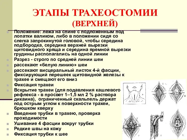 ЭТАПЫ ТРАХЕОСТОМИИ (ВЕРХНЕЙ) Положение: лежа на спине с подложенным под лопатки