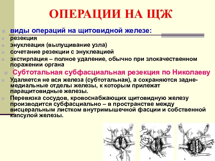 ОПЕРАЦИИ НА ЩЖ виды операций на щитовидной железе: резекция энуклеация (вылущивание