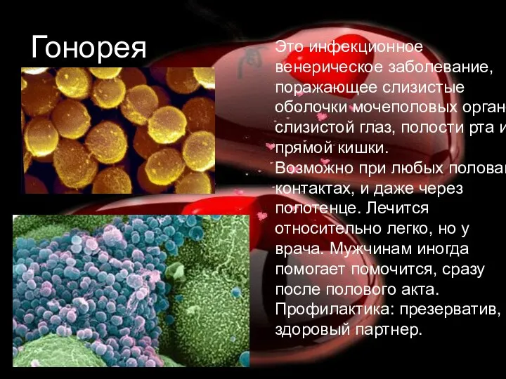 Гонорея Это инфекционное венерическое заболевание, поражающее слизистые оболочки мочеполовых органов, слизистой