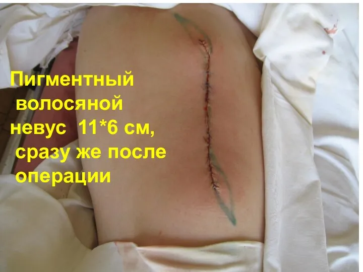 Пигментный волосяной невус 11*6 см, сразу же после операции