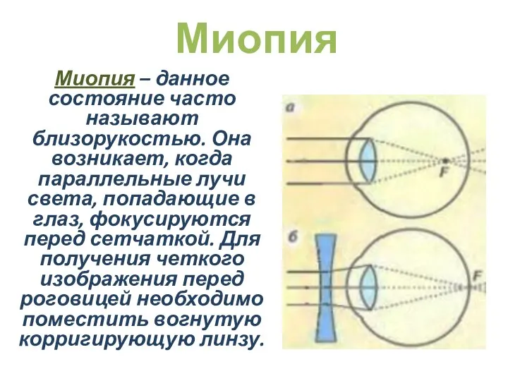 Миопия – данное состояние часто называют близорукостью. Она возникает, когда параллельные