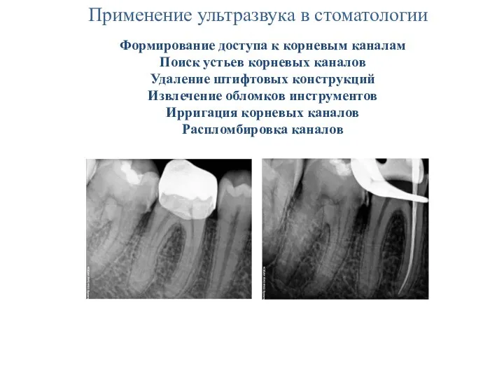 Применение ультразвука в стоматологии Формирование доступа к корневым каналам Поиск устьев