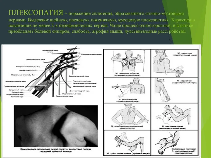 ПЛЕКСОПАТИЯ - поражение сплетения, образованного спинно-мозговыми нервами. Выделяют шейную, плечевую, поясничную,