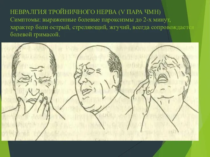 НЕВРАЛГИЯ ТРОЙНИЧНОГО НЕРВА (V ПАРА ЧМН) Симптомы: выраженные болевые пароксизмы до