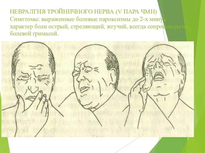 НЕВРАЛГИЯ ТРОЙНИЧНОГО НЕРВА (V ПАРА ЧМН) Симптомы: выраженные болевые пароксизмы до