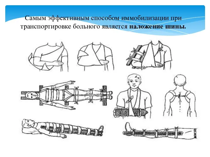 Самым эффективным способом иммобилизации при транспортировке больного является наложение шины.