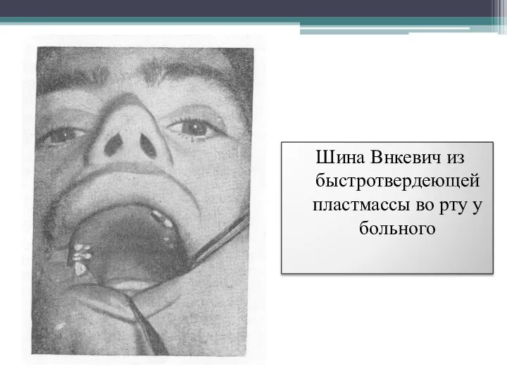 Шина Внкевич из быстротвердеющей пластмассы во рту у больного
