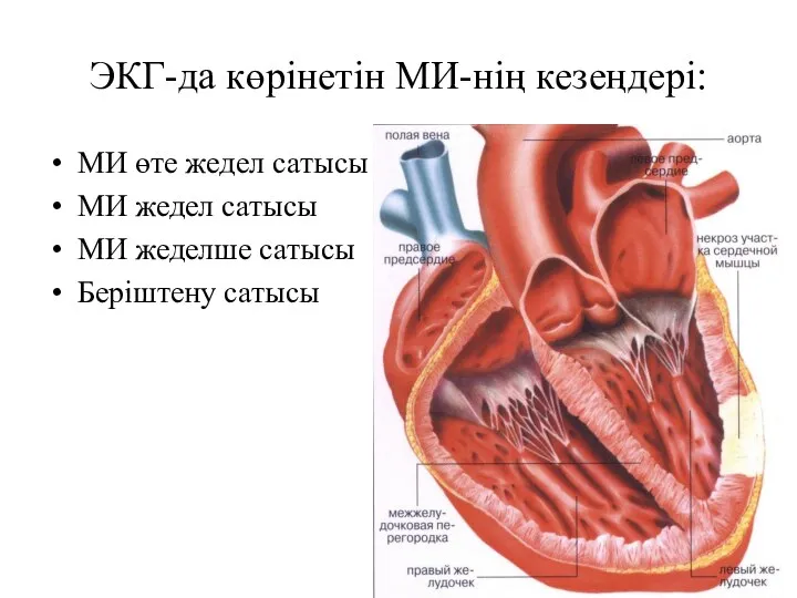 ЭКГ-да көрінетін МИ-нің кезеңдері: МИ өте жедел сатысы МИ жедел сатысы МИ жеделше сатысы Беріштену сатысы