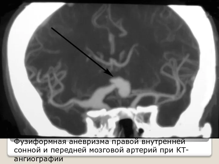 Фузиформная аневризма правой внутренней сонной и передней мозговой артерий при КТ-ангиографии