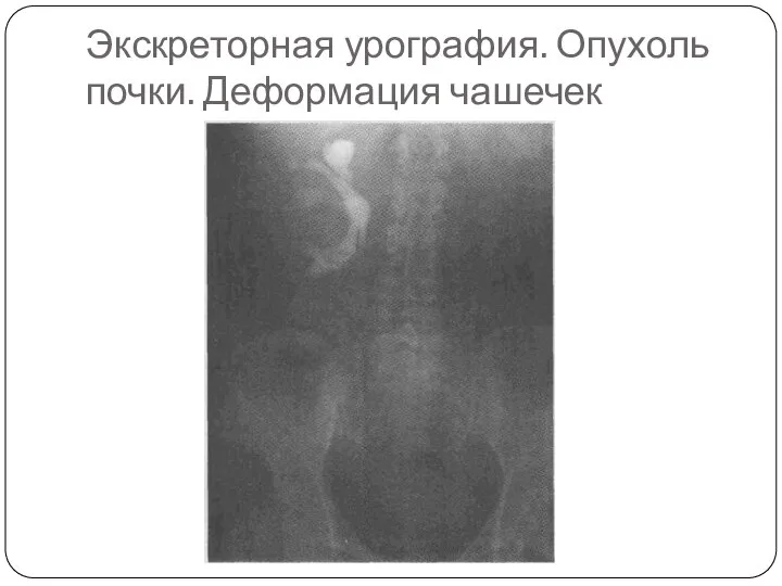 Экскреторная урография. Опухоль почки. Деформация чашечек