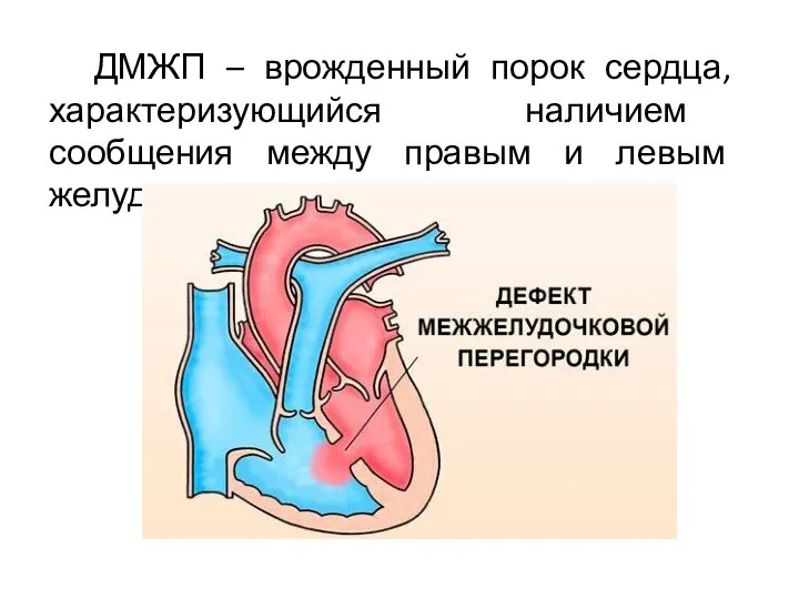 ДМЖП – врожденный порок сердца, характеризующийся наличием сообщения между правым и левым желудочками.