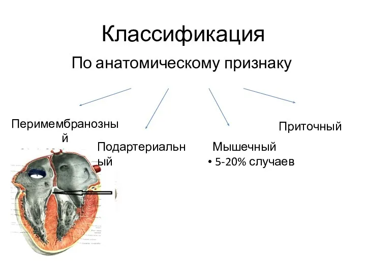 Классификация По анатомическому признаку Перимембранозный 61,4-80% случаев Мышечный 5-20% случаев Приточный Подартериальный