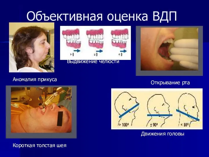 Объективная оценка ВДП Аномалия прикуса Выдвижение челюсти Открывание рта Движения головы Короткая толстая шея