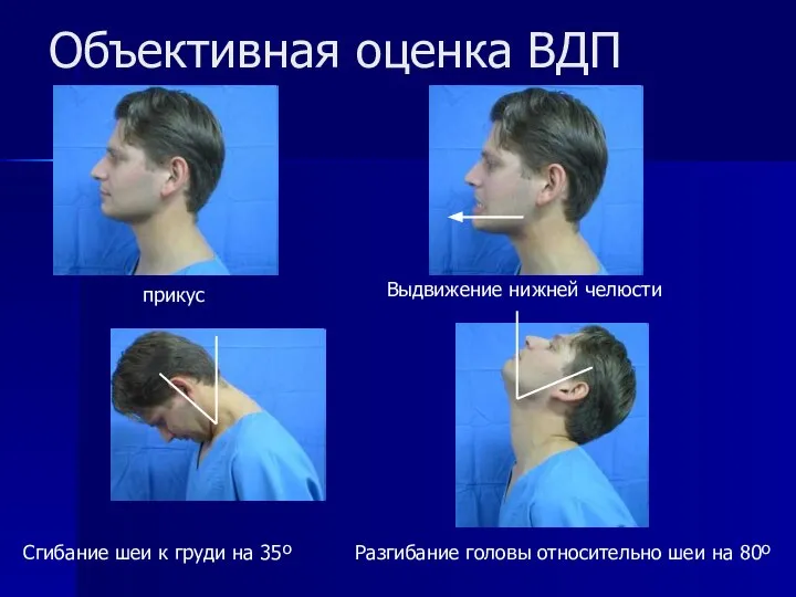 Объективная оценка ВДП прикус Выдвижение нижней челюсти Разгибание головы относительно шеи