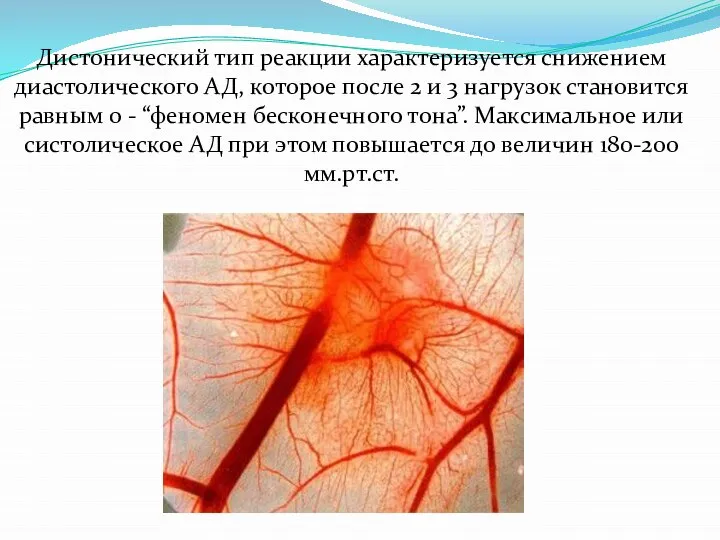 Дистонический тип реакции характеризуется снижением диастолического АД, которое после 2 и