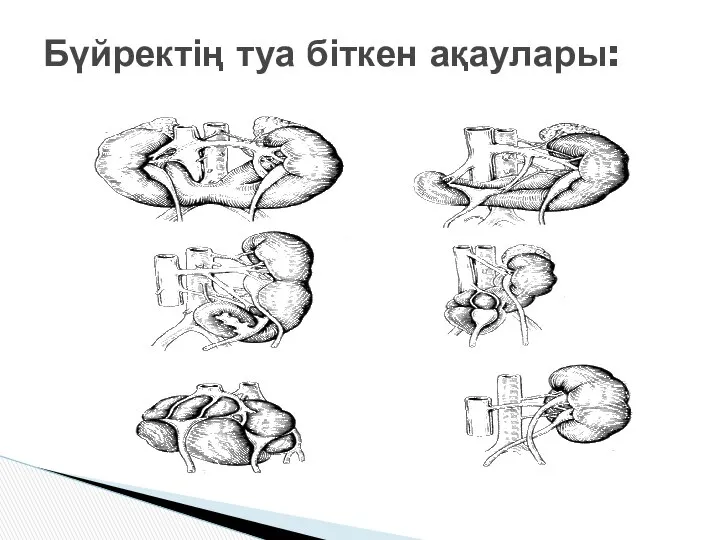 Бүйректің туа біткен ақаулары: