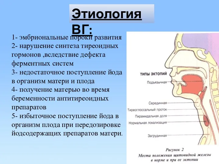 Этиология ВГ: 1- эмбриональные пороки развития 2- нарушение синтеза тиреоидных гормонов