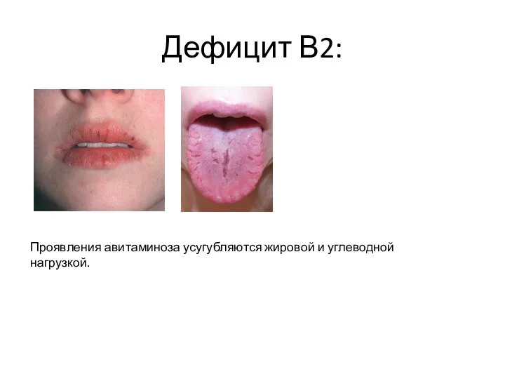 Дефицит В2: Проявления авитаминоза усугубляются жировой и углеводной нагрузкой.