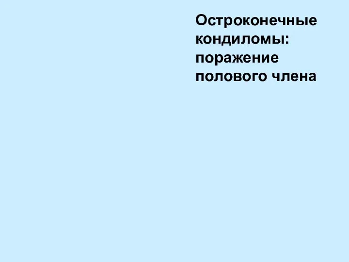 Остроконечные кондиломы: поражение полового члена