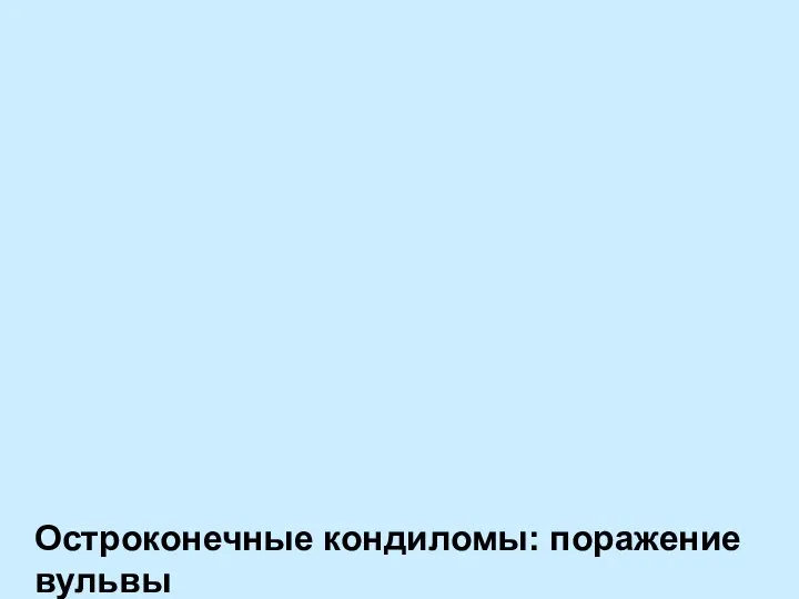 Остроконечные кондиломы: поражение вульвы