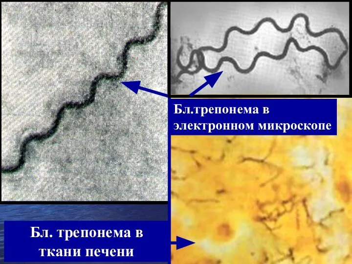 Бл.трепонема в электронном микроскопе Бл. трепонема в ткани печени