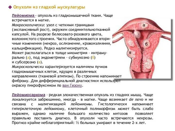 Лейомиосаркома – редкая злокачественная опухоль из гладких мышц. Чаще локализуется забрюшинно,