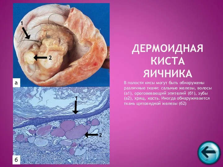 В полости кисы могут быть обнаружены различные ткани: сальные железы, волосы