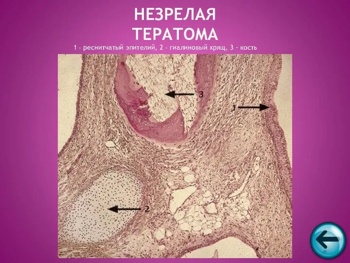 1 – реснитчатый эпителий, 2 – гиалиновый хрящ, 3 - кость НЕЗРЕЛАЯ ТЕРАТОМА