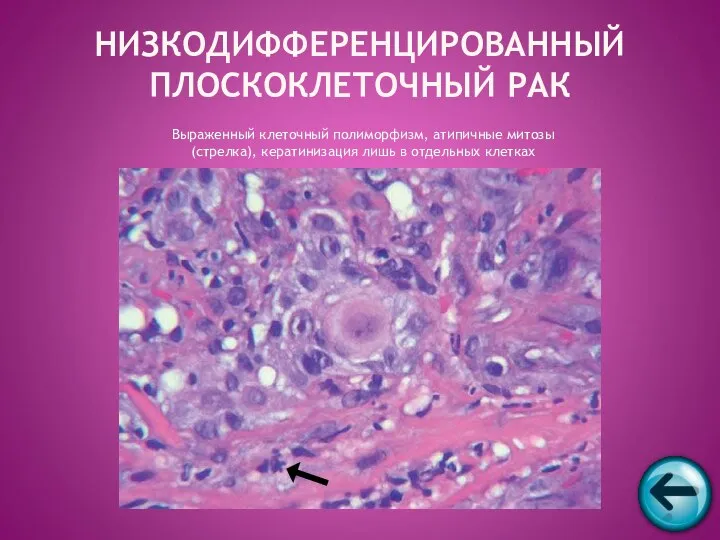 Выраженный клеточный полиморфизм, атипичные митозы (стрелка), кератинизация лишь в отдельных клетках НИЗКОДИФФЕРЕНЦИРОВАННЫЙ ПЛОСКОКЛЕТОЧНЫЙ РАК