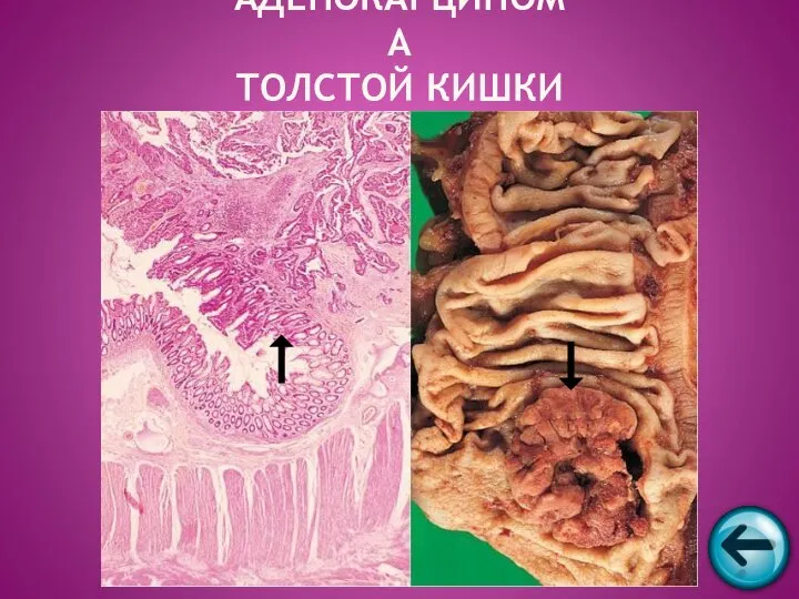 АДЕНОКАРЦИНОМА ТОЛСТОЙ КИШКИ