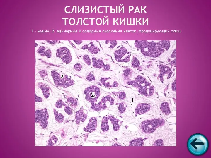 1 - муцин; 2- ацинарные и солидные скопления клеток ,продуцирующих слизь