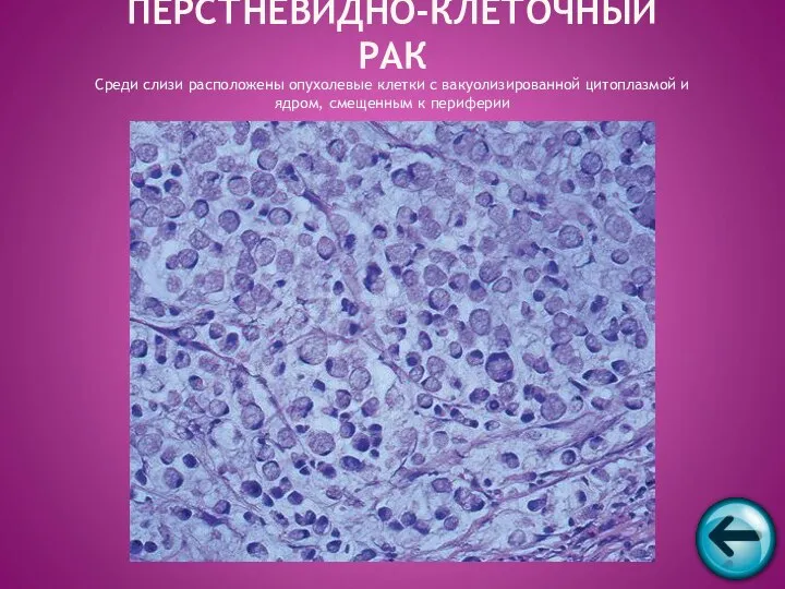 ПЕРСТНЕВИДНО-КЛЕТОЧНЫЙ РАК Среди слизи расположены опухолевые клетки с вакуолизированной цитоплазмой и ядром, смещенным к периферии