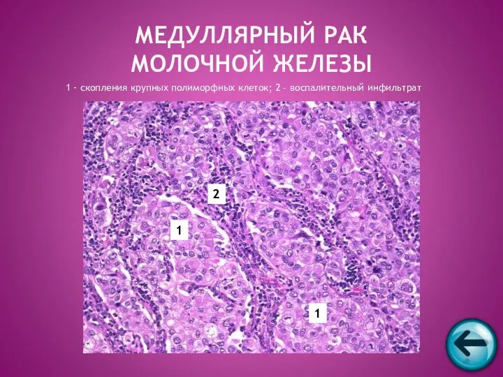 1 - скопления крупных полиморфных клеток; 2 – воспалительный инфильтрат МЕДУЛЛЯРНЫЙ